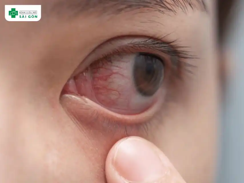 Mụn mắt thường không có biến chứng nguy hiểm