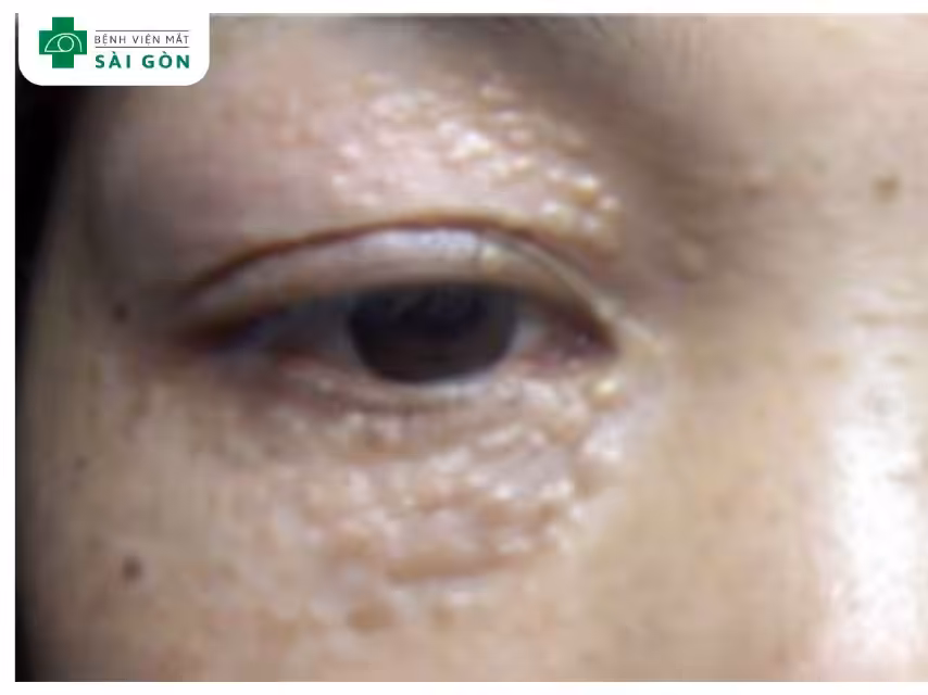 Mụn thịt nổi quanh mắt