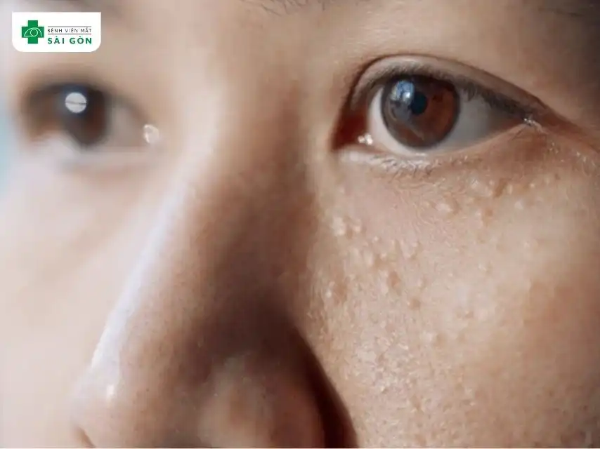 Mụn thịt là các khối u lành tính