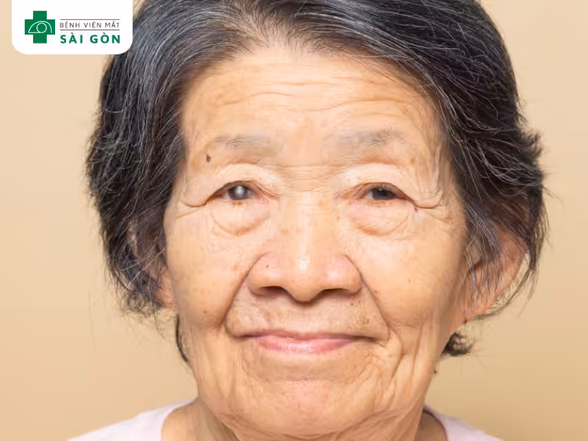 Nguy cơ đục thủy tinh thể