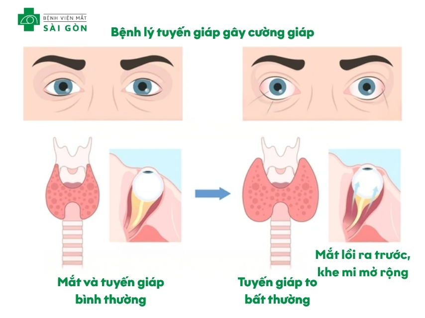 Bệnh Graves làm đau hốc mắt