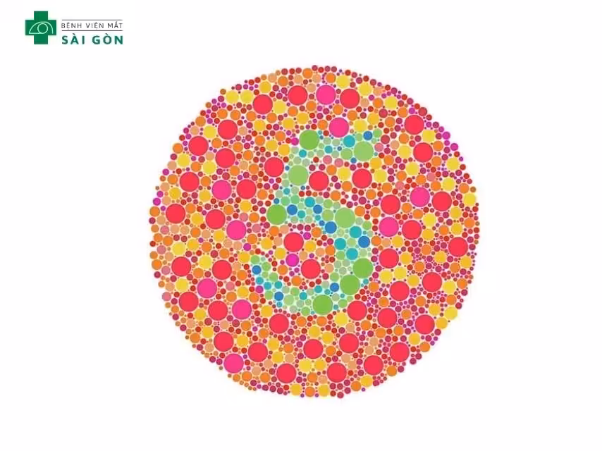 Nguyên nhân phổ biến của bệnh mù màu