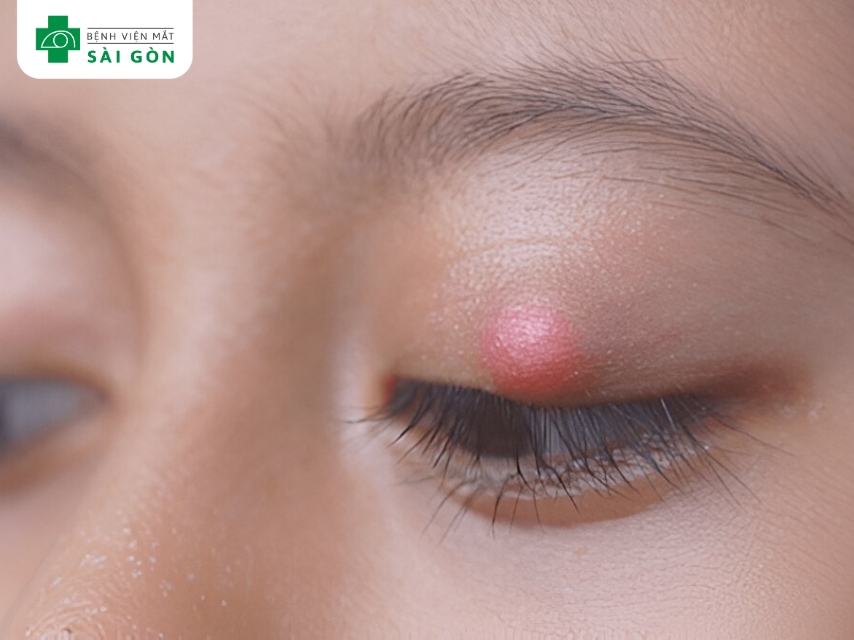 Chắp lẹo làm đau hốc mắt