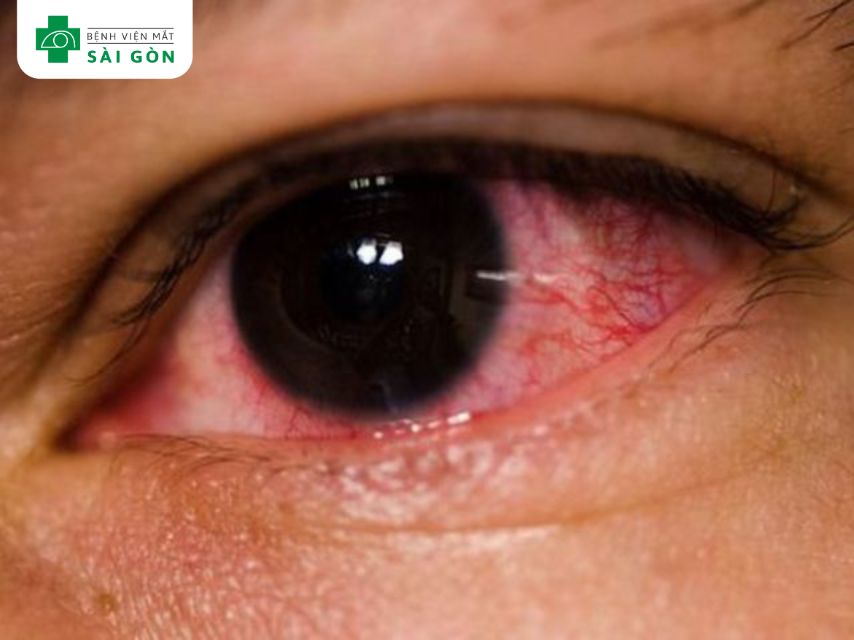 Mắt nhiễm khuẩn