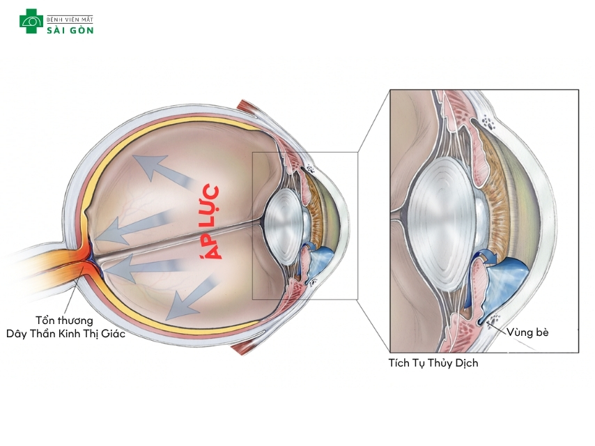 Tích tụ thủy dịch trong mắt gây glaucoma