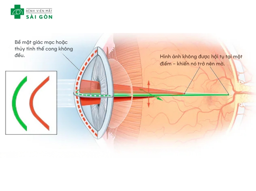 Lão hóa một trong tác nhân gây loạn thị