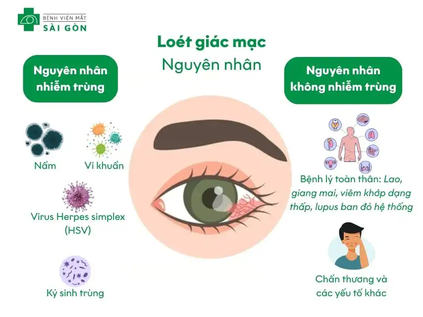 Loét giác mạc