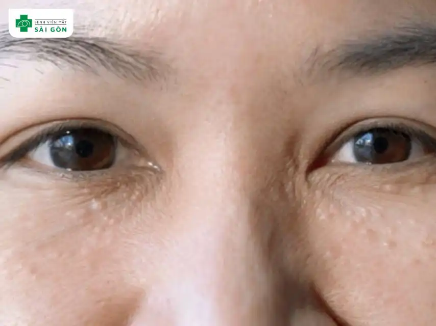 Mụn mắt thường do vi khuẩn gây ra