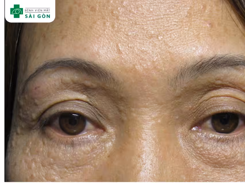 Mụn thịt quanh mắt ở người già