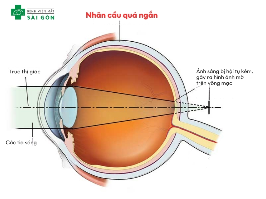Nhẫn cầu ngắn khiến mắt bị viễn thị