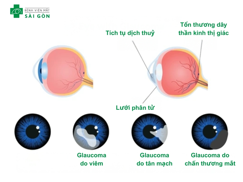 Glaucoma góc đóng cấp tính gây đau hốc mắt