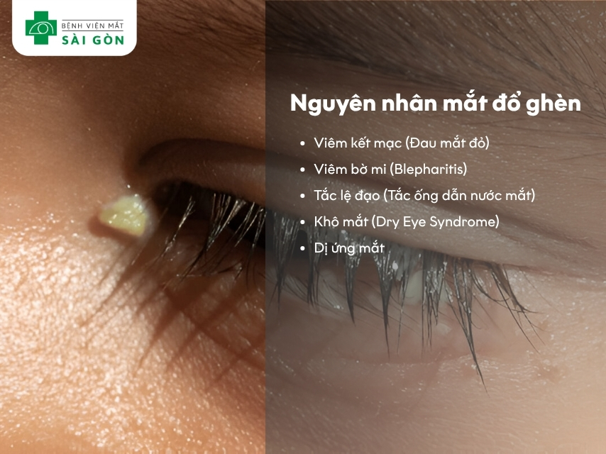 Các nguyên nhân khiến mắt đổ ghèn