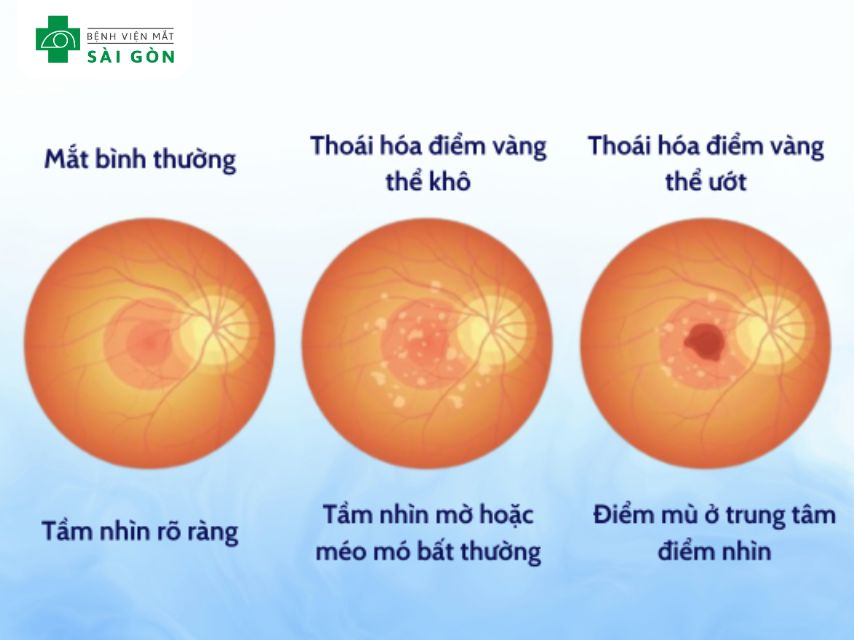 Nguyên nhân mắt bị mờ như có màng che