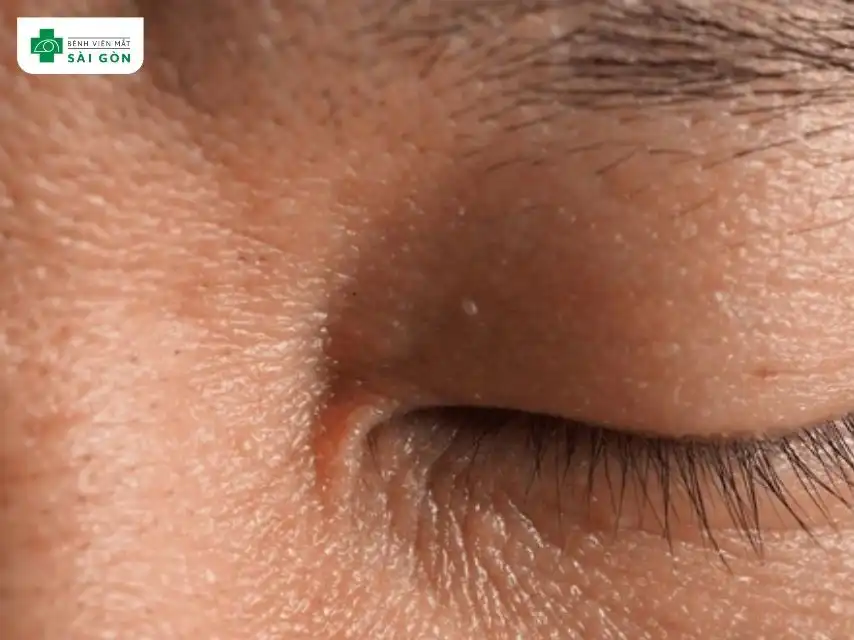 Nguyên nhân phổ biến nhất là hạt kê