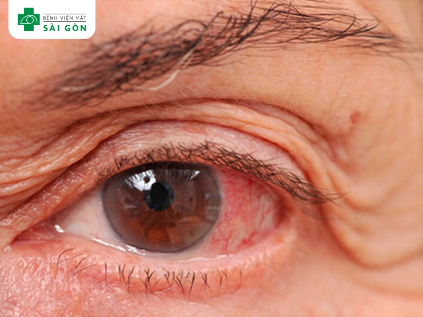 Tăng nhãn áp gây đau hốc mắt