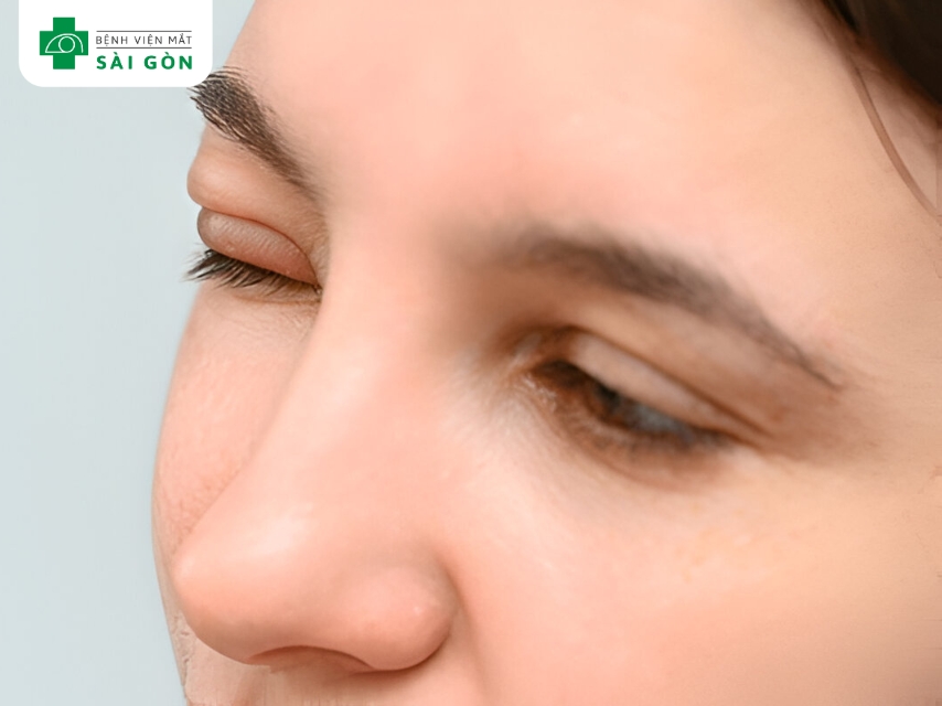 Viêm bờ mi gây đau hốc mắt