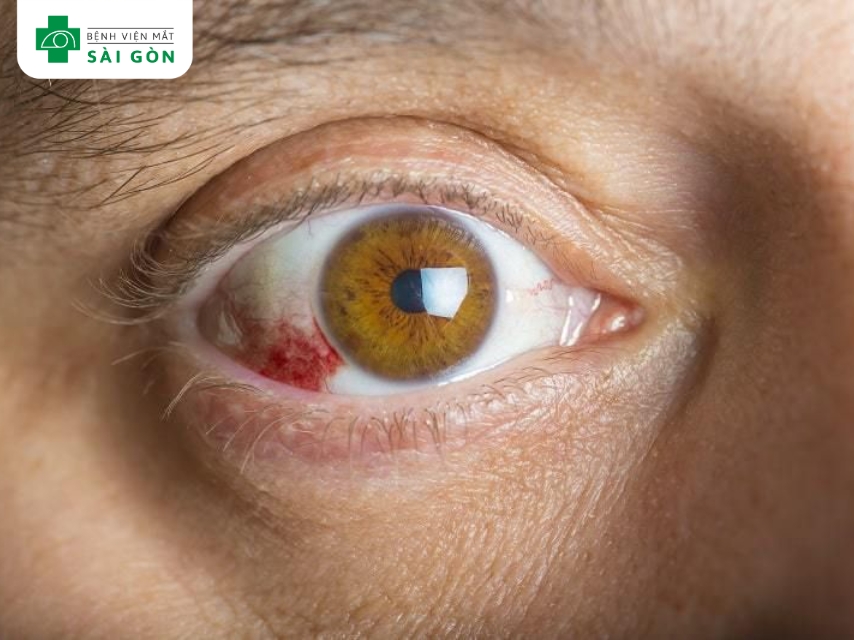 Viêm củng mạc gây đau hốc mắt