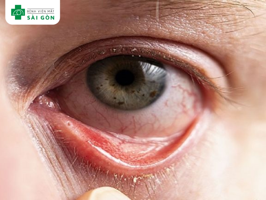 Viêm giác mạc gây đau hốc mắt
