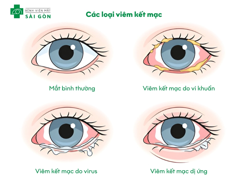Viêm kết mạc làm đau hốc mắt