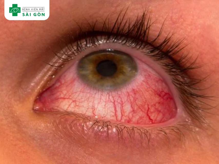 Viêm màng bồ đào gây đau hốc mắt