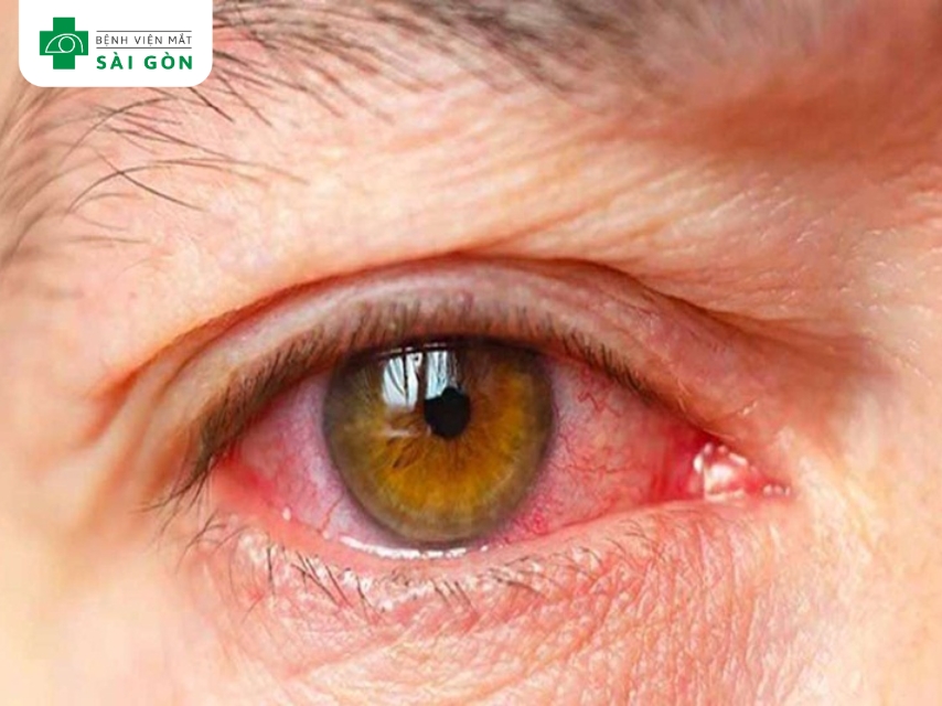 Viêm mống mắt gây đau hốc mắt