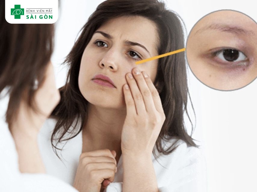 Nhận biết quầng thâm mắt