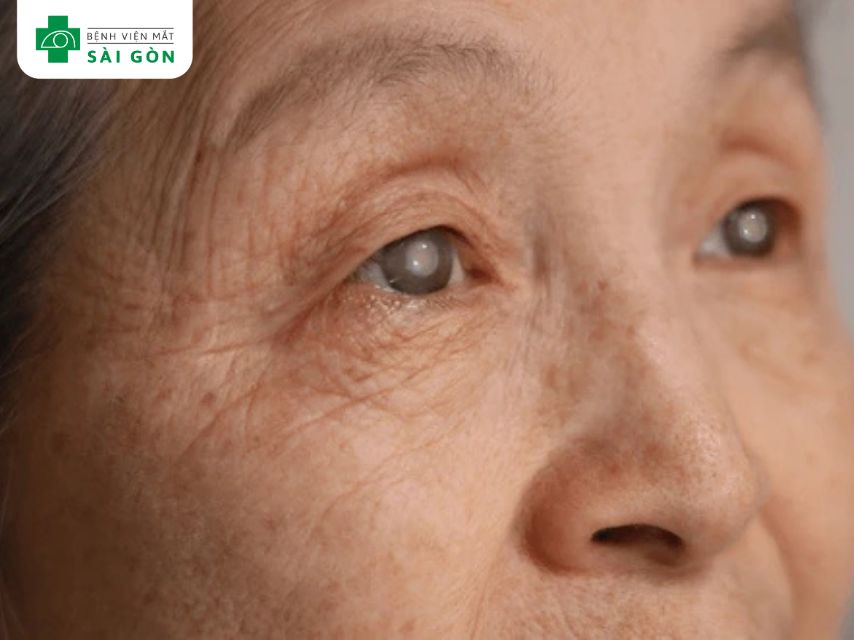 Người cao tuổi nheo mắt