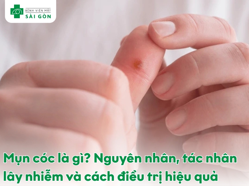 Tìm hiểu về bệnh da liễu mụn cóc