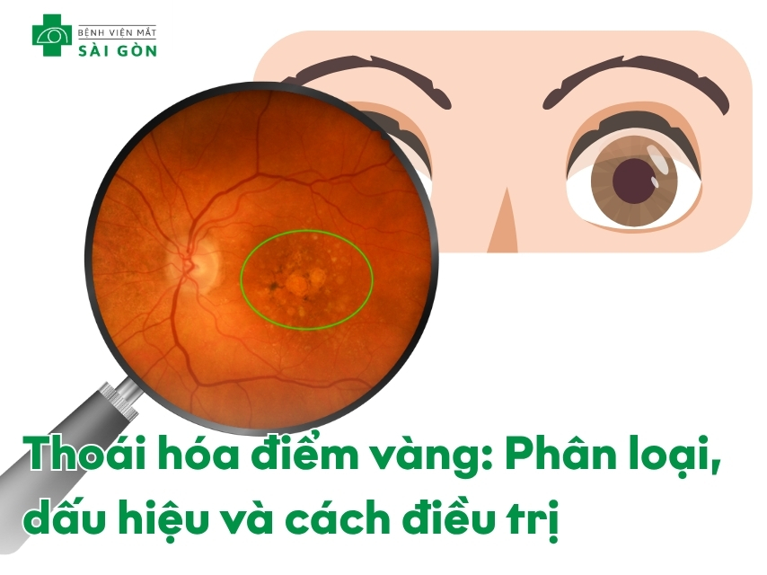 Thoái hóa điểm vàng ảnh hưởng đến khả năng nhìn rõ