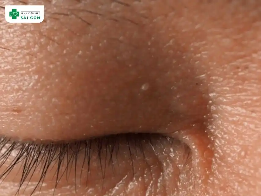Nổi mụn trắng ở mí mắt trên là các tổn thương nhỏ có màu trắng hoặc vàng nhạt