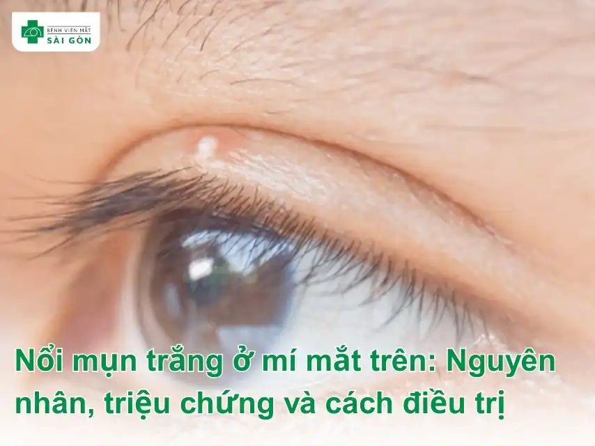 Tình trạng nổi mụn trắng ở mí mắt trên