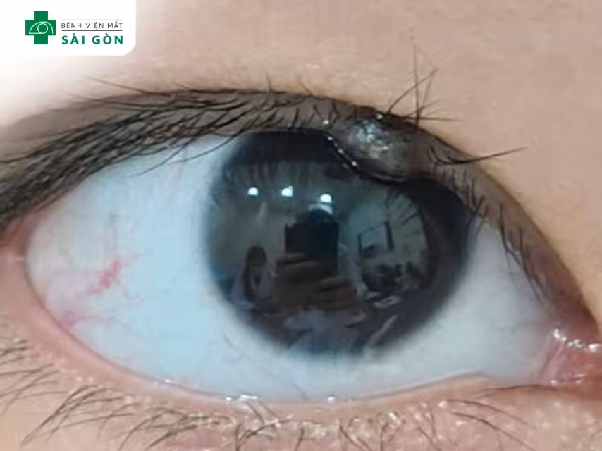 Nốt ruồi ở mắt là gì