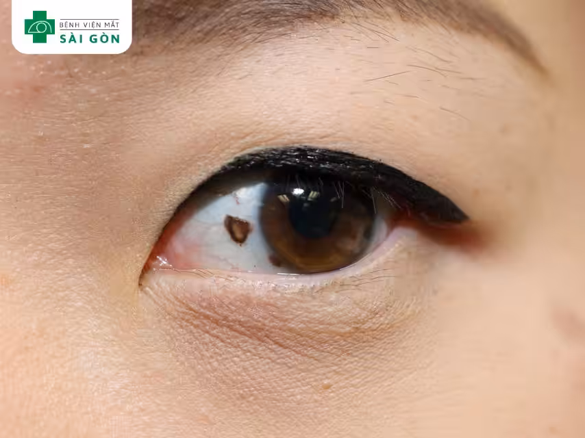 Nốt ruồi trong mắt