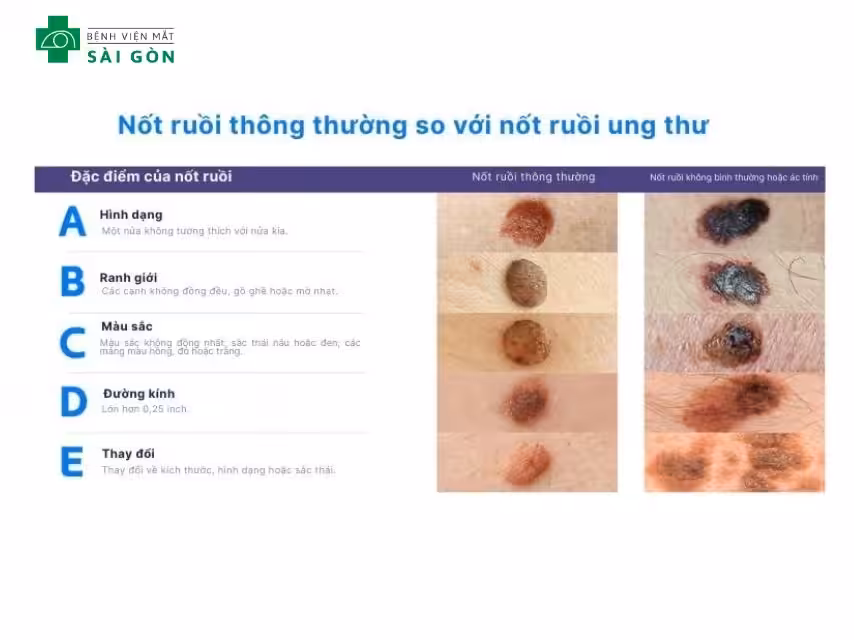 Phân biệt nốt ruồi lành tính
