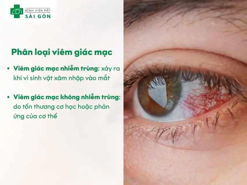 Viêm giác mạc phân thành 2 loại gồm nhiễm trùng và không nhiễm trùng.