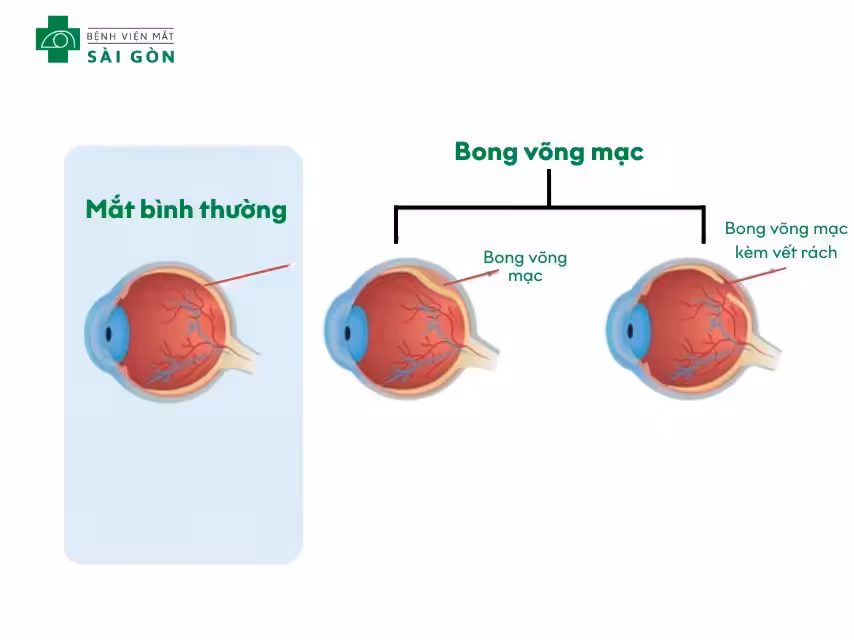 Bong võng mạc do rách
