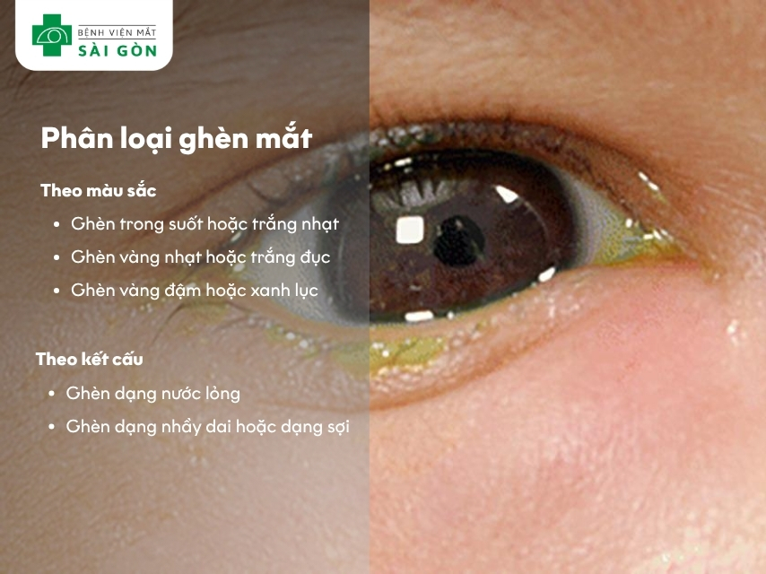 Phân loại hình dáng ghèn mắt