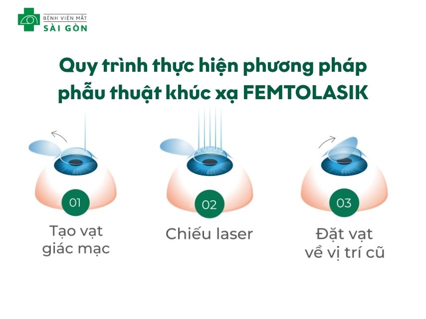Phẫu thuật LASIK với phương pháp FEMTOLASIK