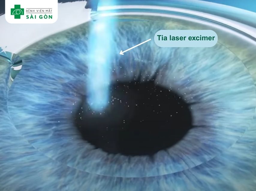 Lasik dùng tia laser excime
