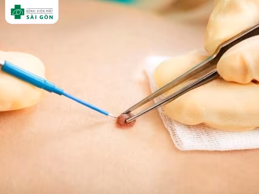Phẫu thuật cắt bỏ nốt ruồi ác tính