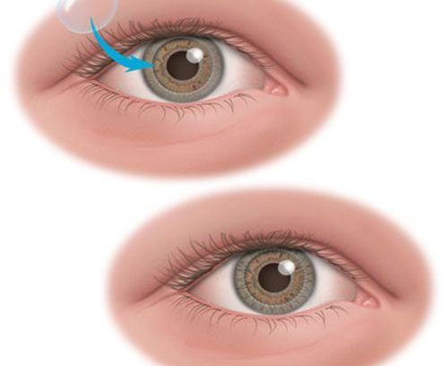 Phương pháp chăm sóc mắt sau phẫu thuật ghép giác mạc