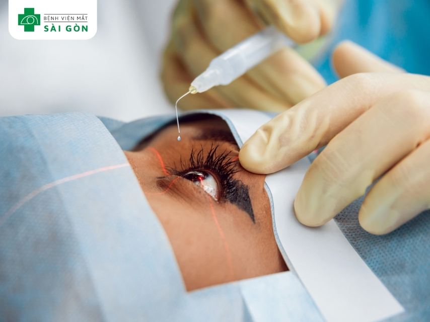 Phẫu thuật điều trị mắt lồi