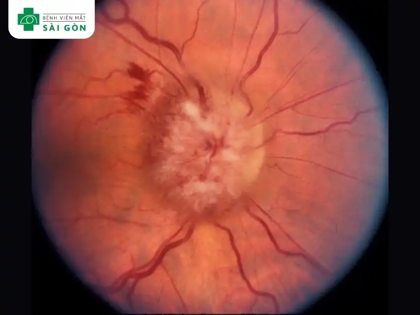 Phù gai thị là tình trạng sưng (phù nề) của đĩa thị thần kinh