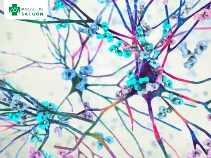 Phù gai thị là tình trạng sưng đĩa thị giác – phần đầu của dây thần kinh thị giác