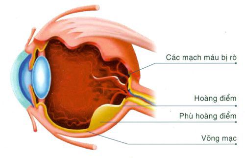 Biến chứng phù hoàng điểm ở bệnh nhân đái tháo đường - Bệnh Viện Mắt Sài Gòn