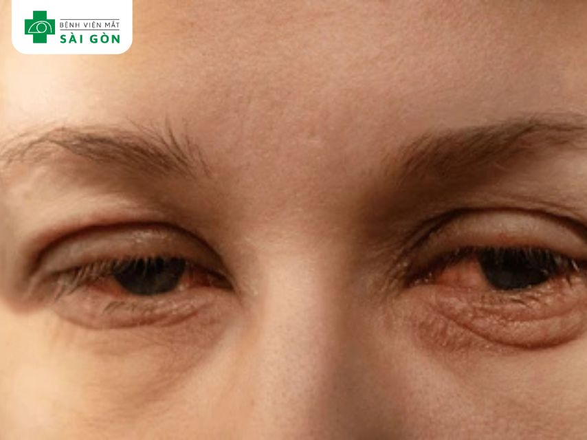 Phù kết mạc (chemosis)