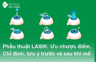 Khái niệm phẫu thuật LASIK, độ an toàn và ưu nhược điểm