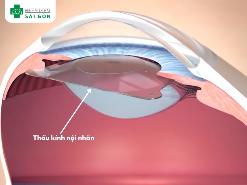 Phương pháp mổ cận PHAKIC tại Mắt Sài Gòn