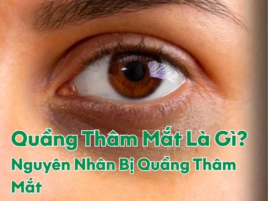 Quầng thâm mắt là gì