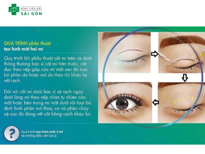 Thời gian phẫu thuật cắt mí mắt